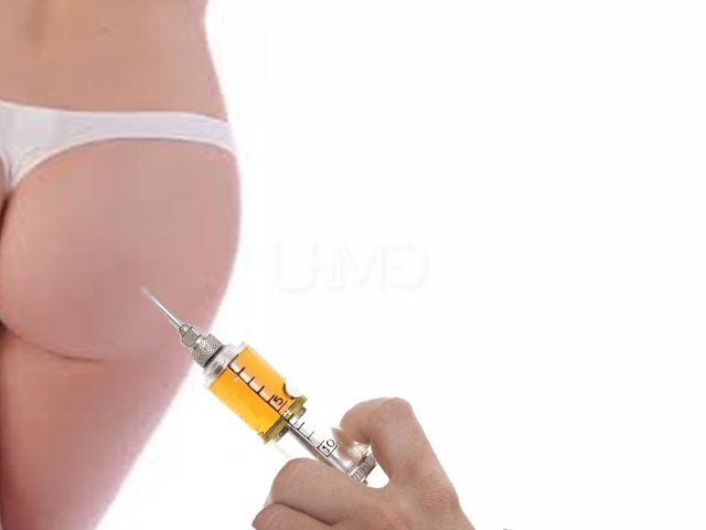 Butt augmentation with fat injection