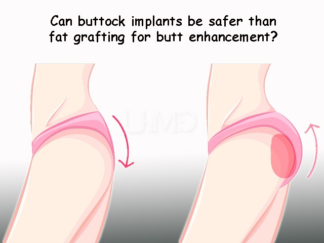 Butt implants vs fat grafting