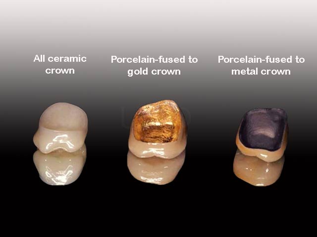 gold tooth crown vs porcelain