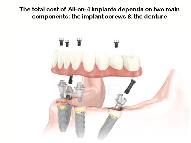 Cost of all on 4 dental implants