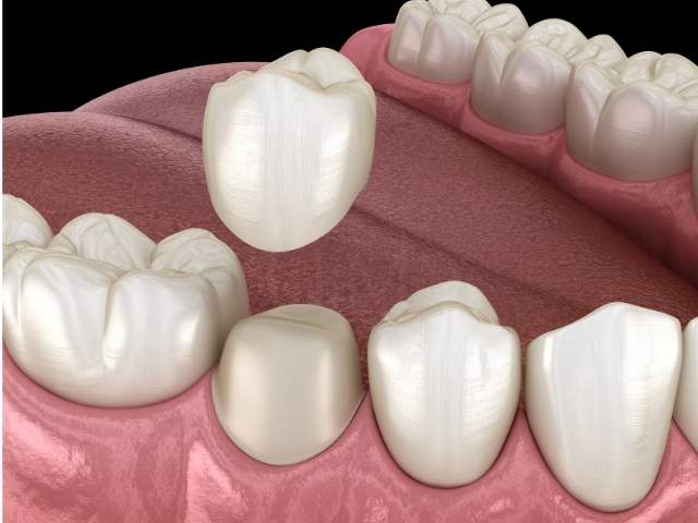 Dental crown placement