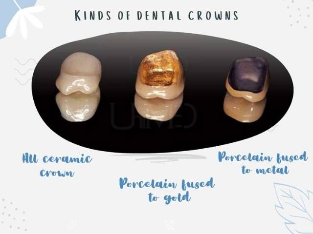 Different kinds of dental crowns