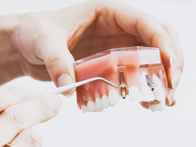 Low cost dental implants