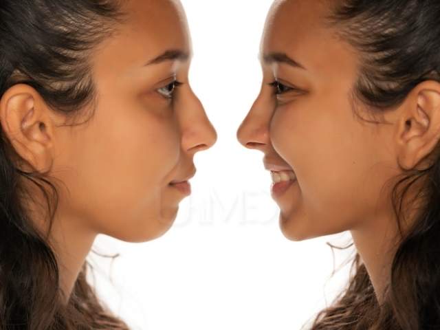 Nose job Thailand before after