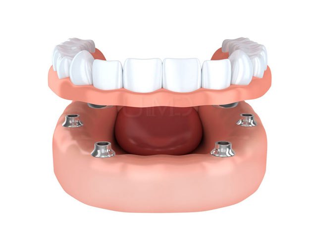 Snap-on-dentures pros and cons