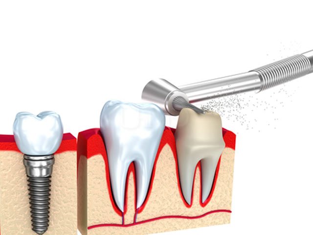 Tooth preparation for dental crown