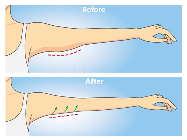Arm lift surgery - Before and After