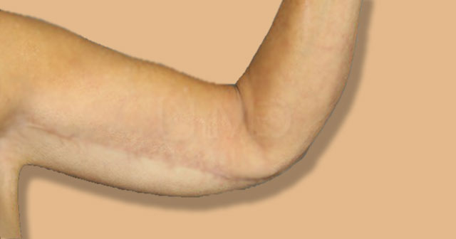 Arm lift scars