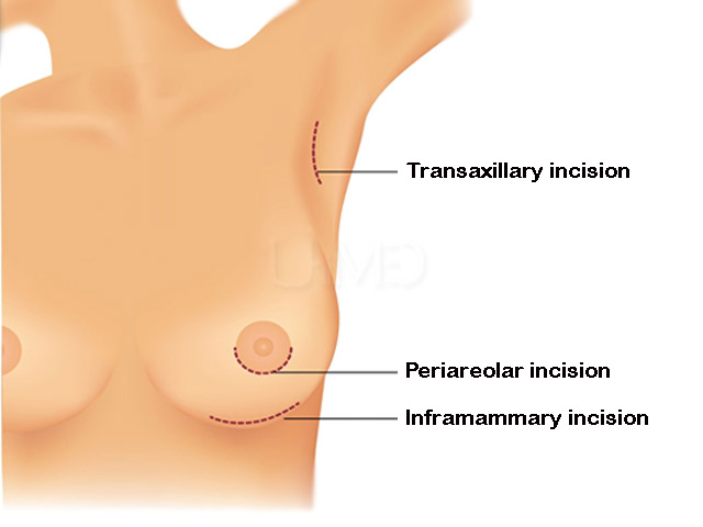 Breast implants - incisions