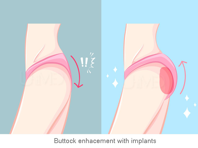 Butt Implants Overseas