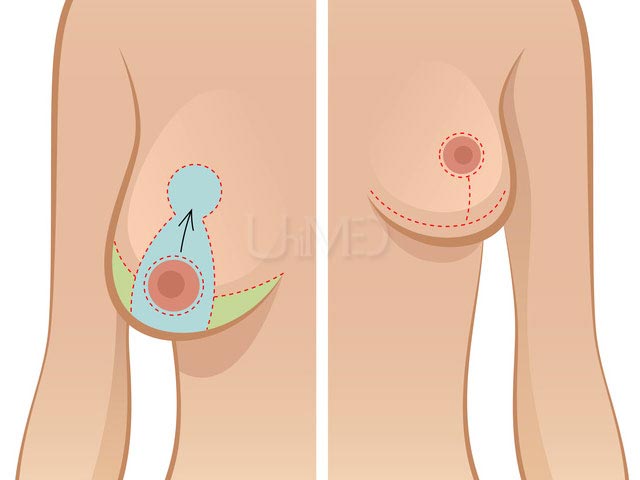 Incisions for breast lift surgery