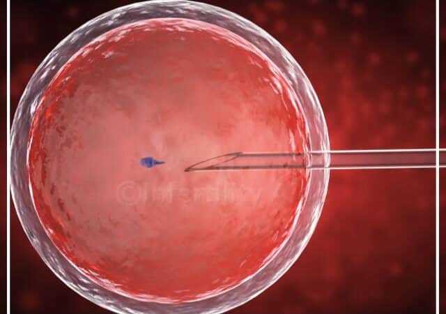 How successful is IVF with endometriosis